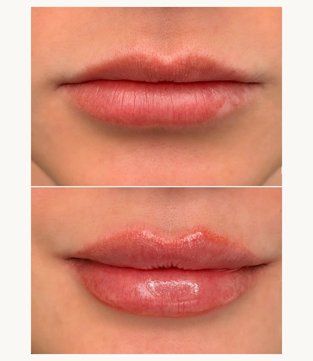 Before and after a lip filler treatment at Hera Clinic